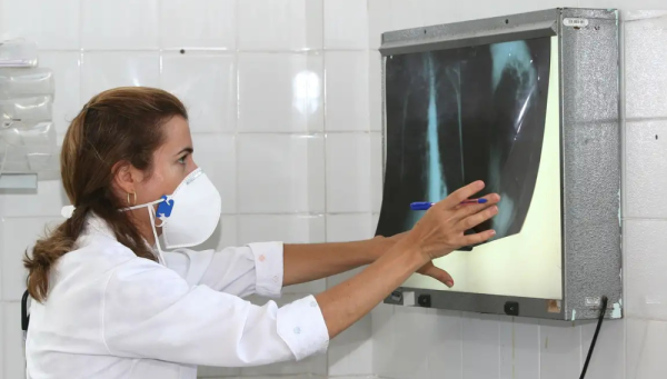 Tuberculose registra quase 86 mil novos casos no Brasil; vacina BCG protege bebês da doença